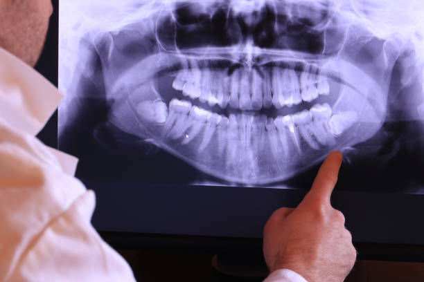 Best Emergency Wisdom Teeth Removal in Columbus, TX